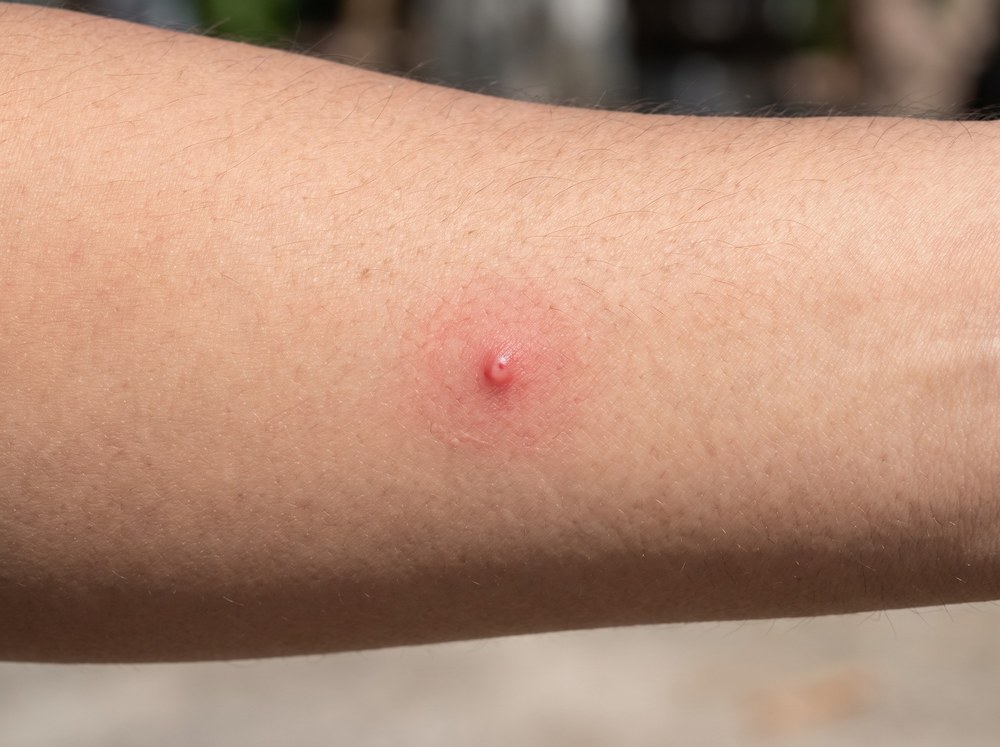 Close-up photograph of small red itchy bite bumps clustered on an ankle after beach exposure