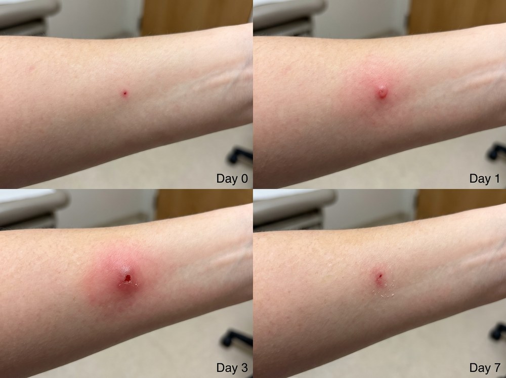 Side-by-side labeled comparison photo showing clustered sand bug bite marks on an ankle next to a single mosquito bite welt